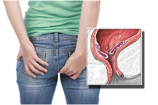 Apakah wasir stadium 3 bisa sembuh tanpa operasi, cara mengatasi penyakit ambeien alami, jual obat wasir di liwa, gejala penyakit ambeien atau wasir dan obat, jual obat wasir di luwuk, obat ambeyen beli di apotik, mengobati ambeien atau wasir secara alami dan cepat, jual obat buat penyakit ambeien di sekayu, obat wasir atau ambeien ampuh tanpa operasi, cara menghilangkan penyakit ambeyen dgn cepat, jual obat untuk penyakit wasir di teluk dalam